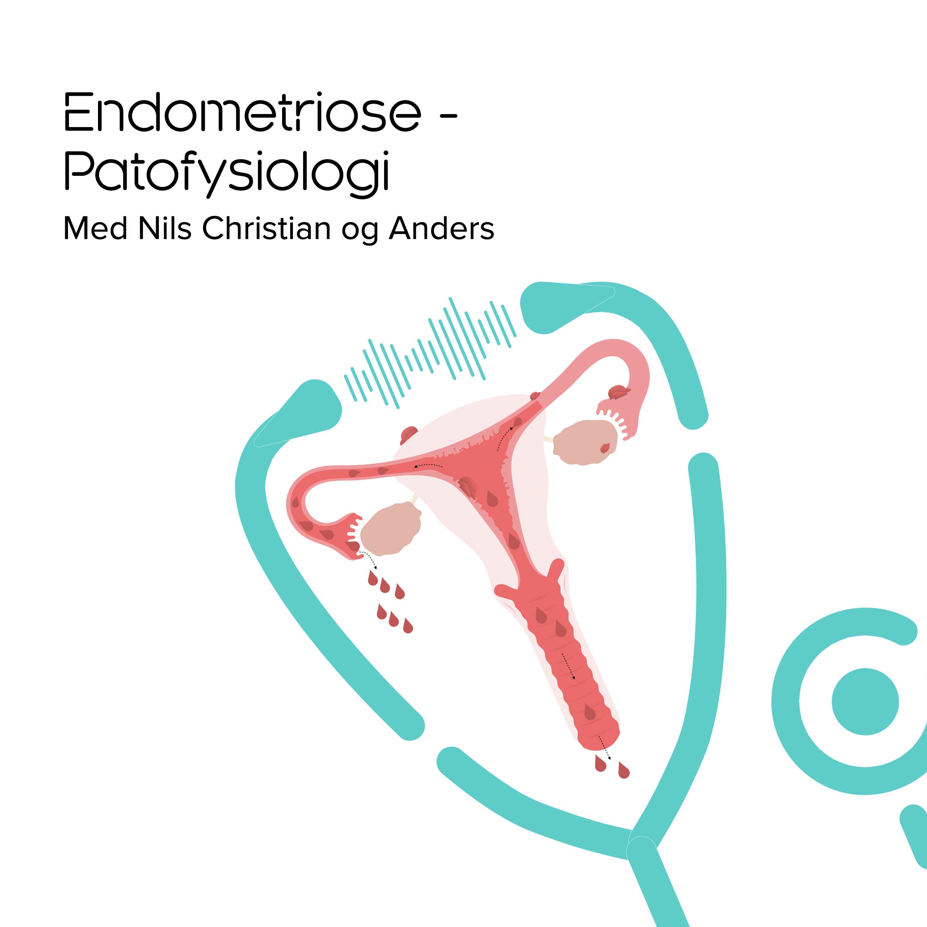 Endometriose - patofysiologi